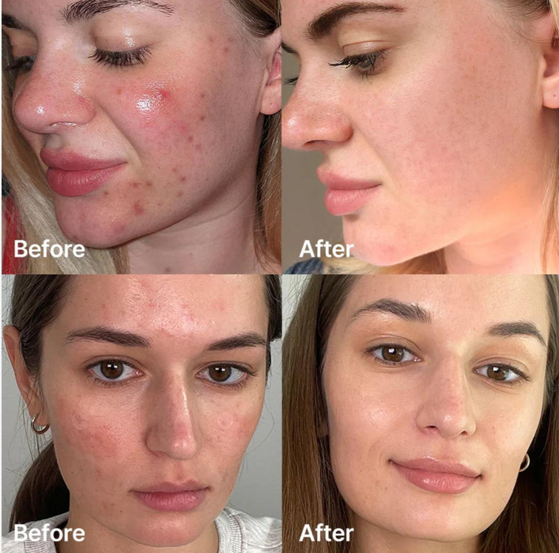 Red Succinic Acid Serum(Niacinamide+Salicylic Acid)